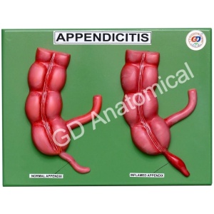 Appendicitis Model