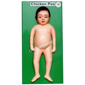Chickenpox Model