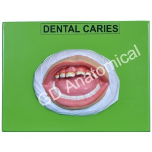 Dental Caries Model