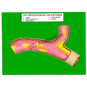 Fat Deposition In The Arteries