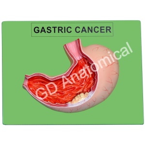 Gastric Cancer Model
