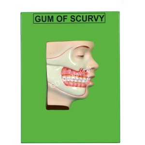 Gum of Scurvy Model