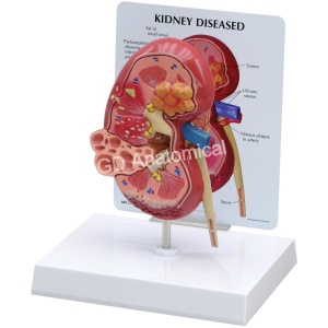 Kidney Disease Model