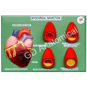 Myocardial Infarction Model