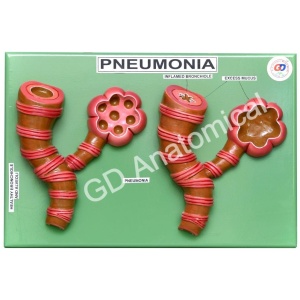 Pneumonia Model