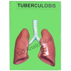 Tuberculosis Model